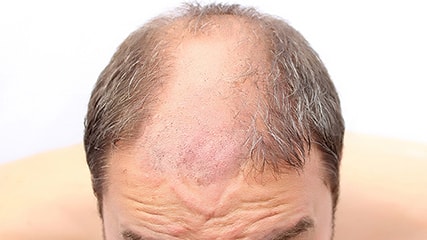 baldness treatment in Navsari