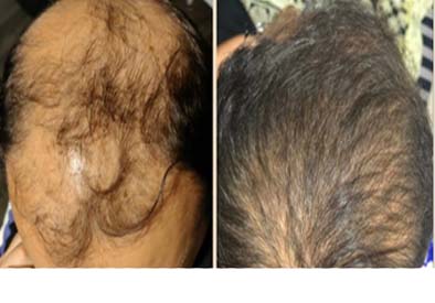 Best Hair Regrowth treatment in Navsari