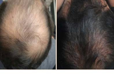 Trusted Hair Regrowth treatment in Navsari