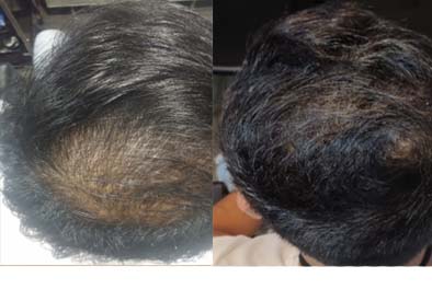 Certified Hair Regrowth treatment in Navsari