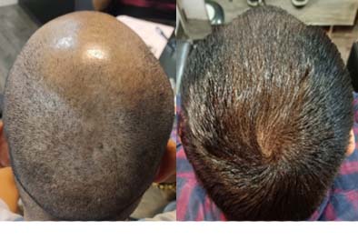most acclaimed Hair Regrowth treatment in Navsari