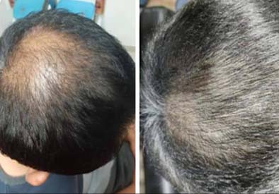 Natural Hair Regrowth treatment in Navsari